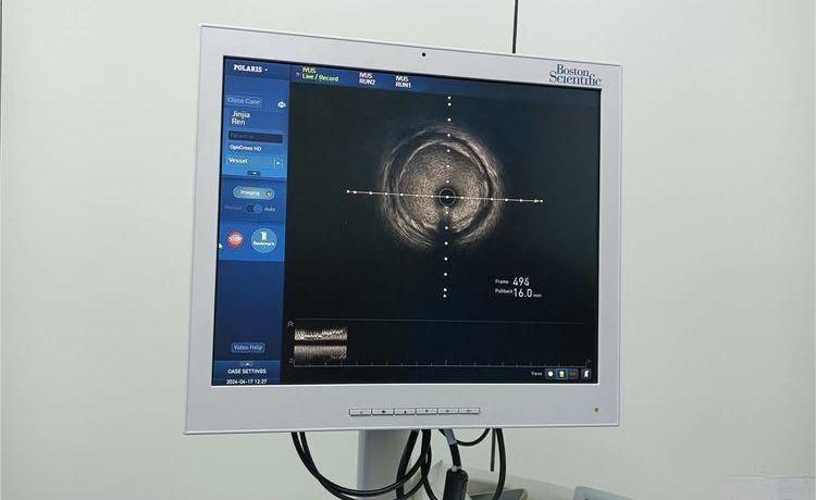 简篇-【周中医·专科风采】周至县中医医院顺利开展首例血管内超声（IVUS）检查，并精准植入冠脉内支架