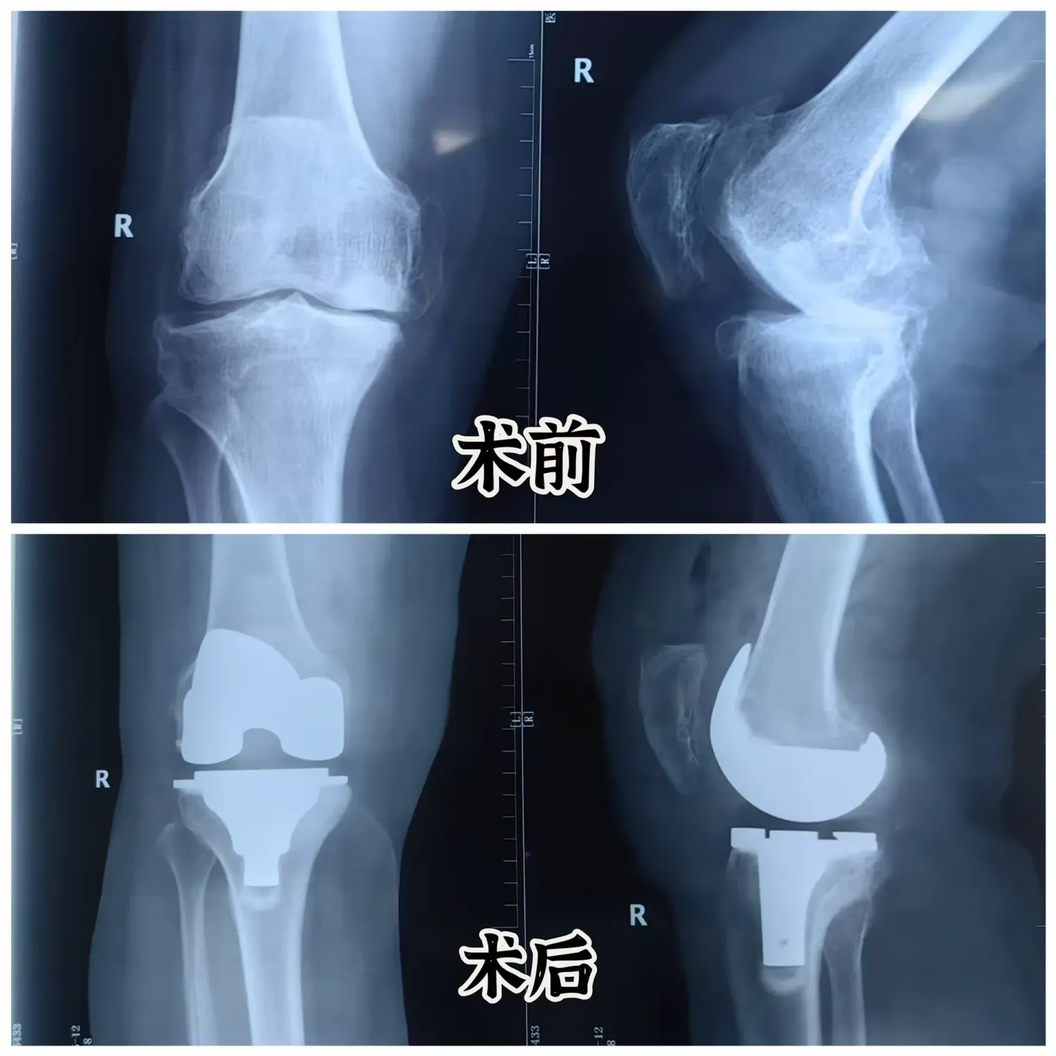 简篇-从“输血”到“造血”——周至县中医医院骨伤科携手上级医院专家完成高难度关节置换术