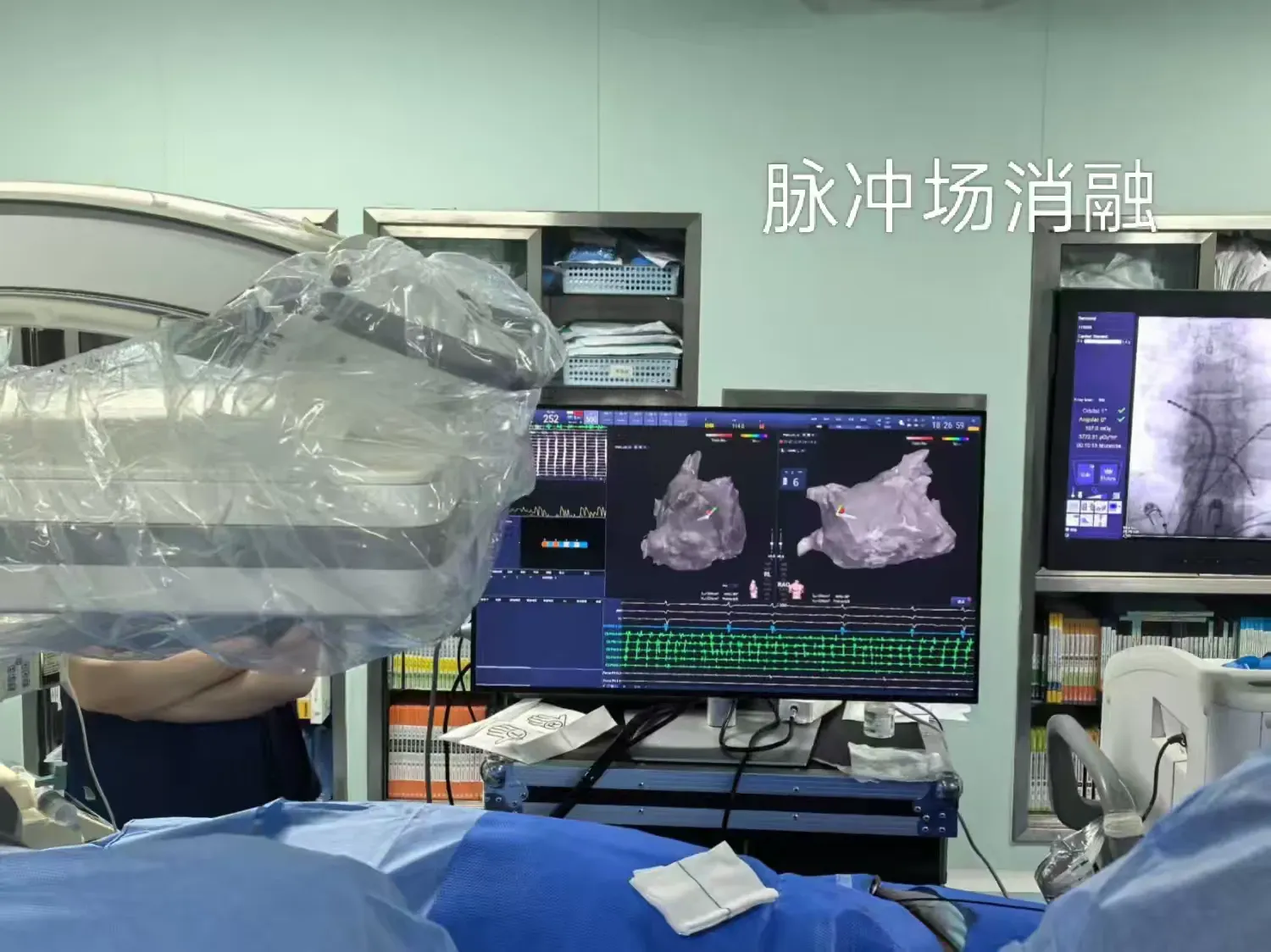 简篇-再添天团级教授帮扶，科室建设迈入快车道——蓝田县中医医院心病科团队成功完成县域内第二例房颤脉冲电场消融术