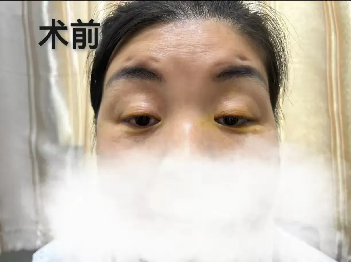 简篇-【眼科动态】重绽明眸光彩 ——我院眼科成功为上睑下垂患者实施矫正手术