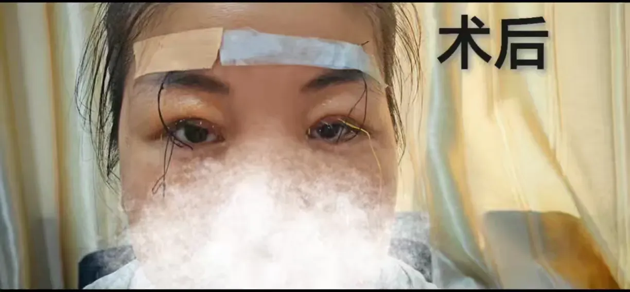简篇-【眼科动态】重绽明眸光彩 ——我院眼科成功为上睑下垂患者实施矫正手术