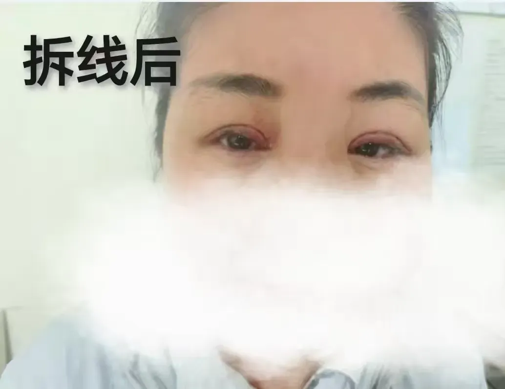 简篇-【眼科动态】重绽明眸光彩 ——我院眼科成功为上睑下垂患者实施矫正手术