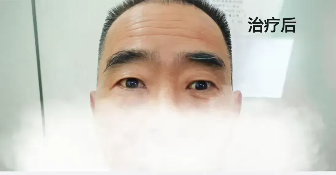 簡篇-【眼科動態(tài)】重獲清晰“視”界，他們在這兒找回了眼健康 ——動眼神經(jīng)麻痹患者康復紀實