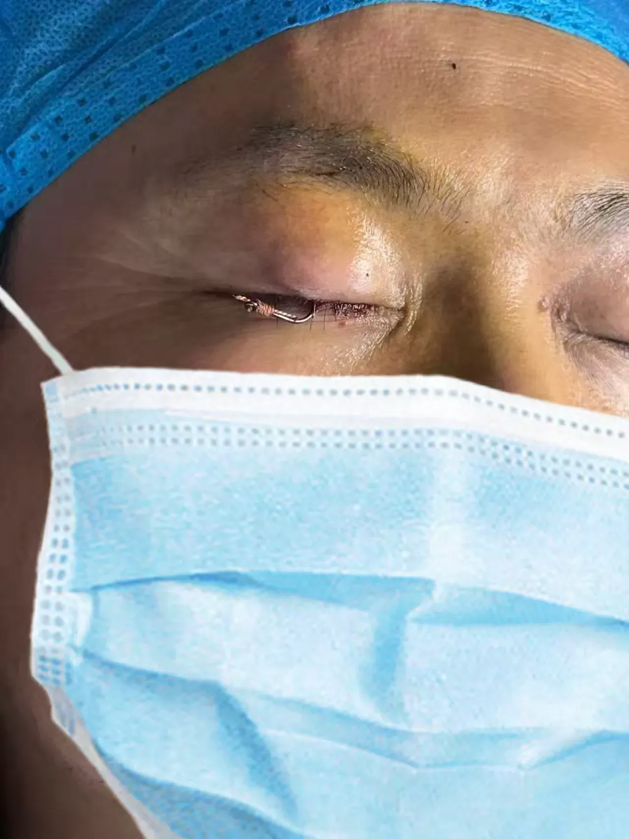 简篇-【多科联动】 跨科协作显担当，精准施救暖人心 ——我院眼科与外科联手化解钓鱼意外危机