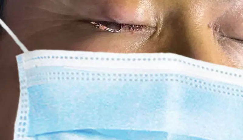 简篇-【多科联动】 ﻿跨科协作显担当，精准施救暖人心 ﻿——我院眼科与外科联手化解钓鱼意外危机