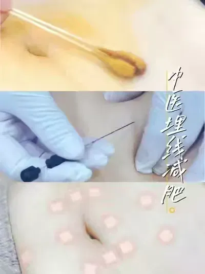 简篇-【锦旗故事】锦旗背后的健康蜕变——穴位埋线领衔，绿色减重显奇效