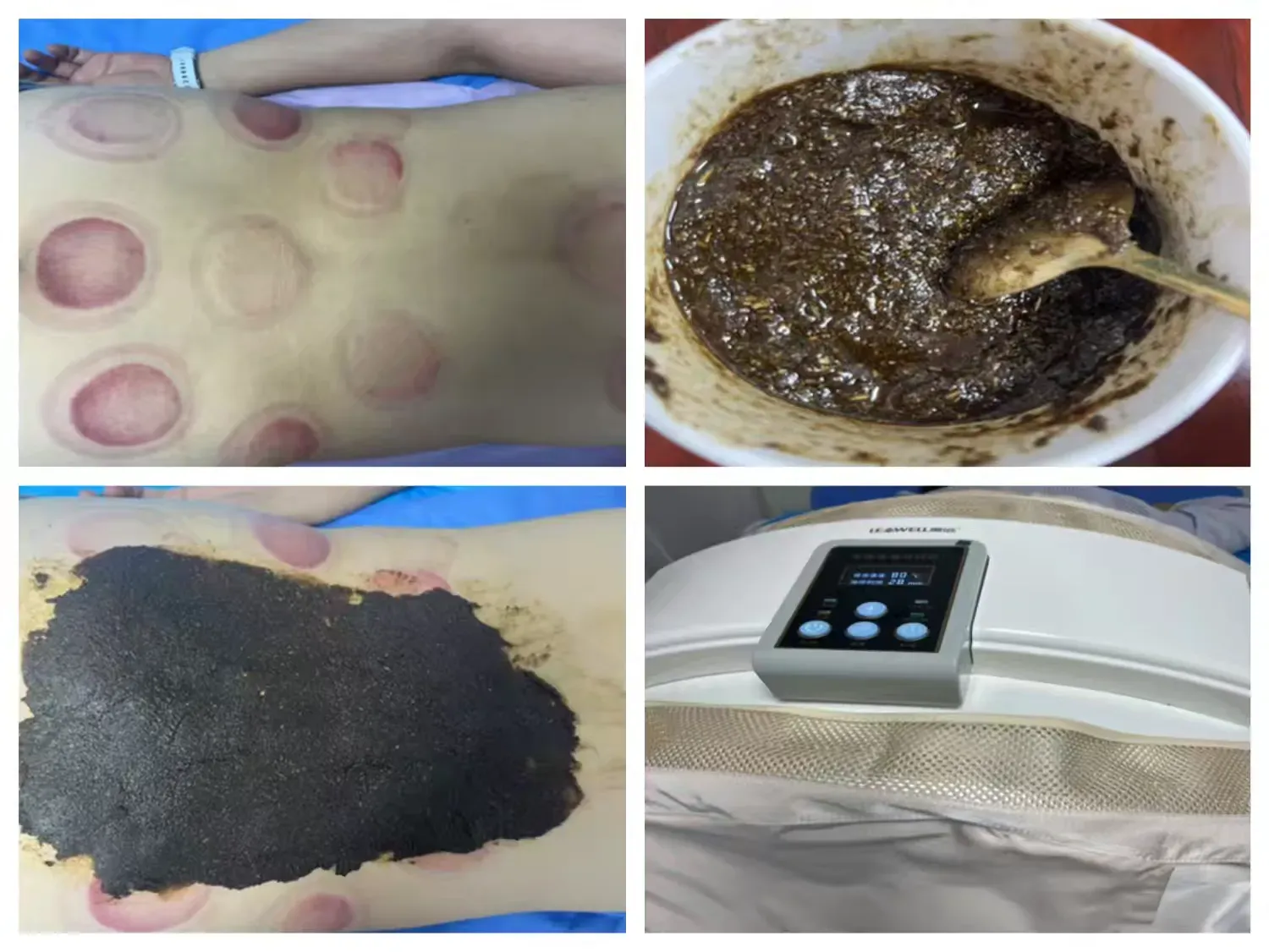 简篇-【锦旗故事】锦旗背后的健康蜕变——穴位埋线领衔，绿色减重显奇效