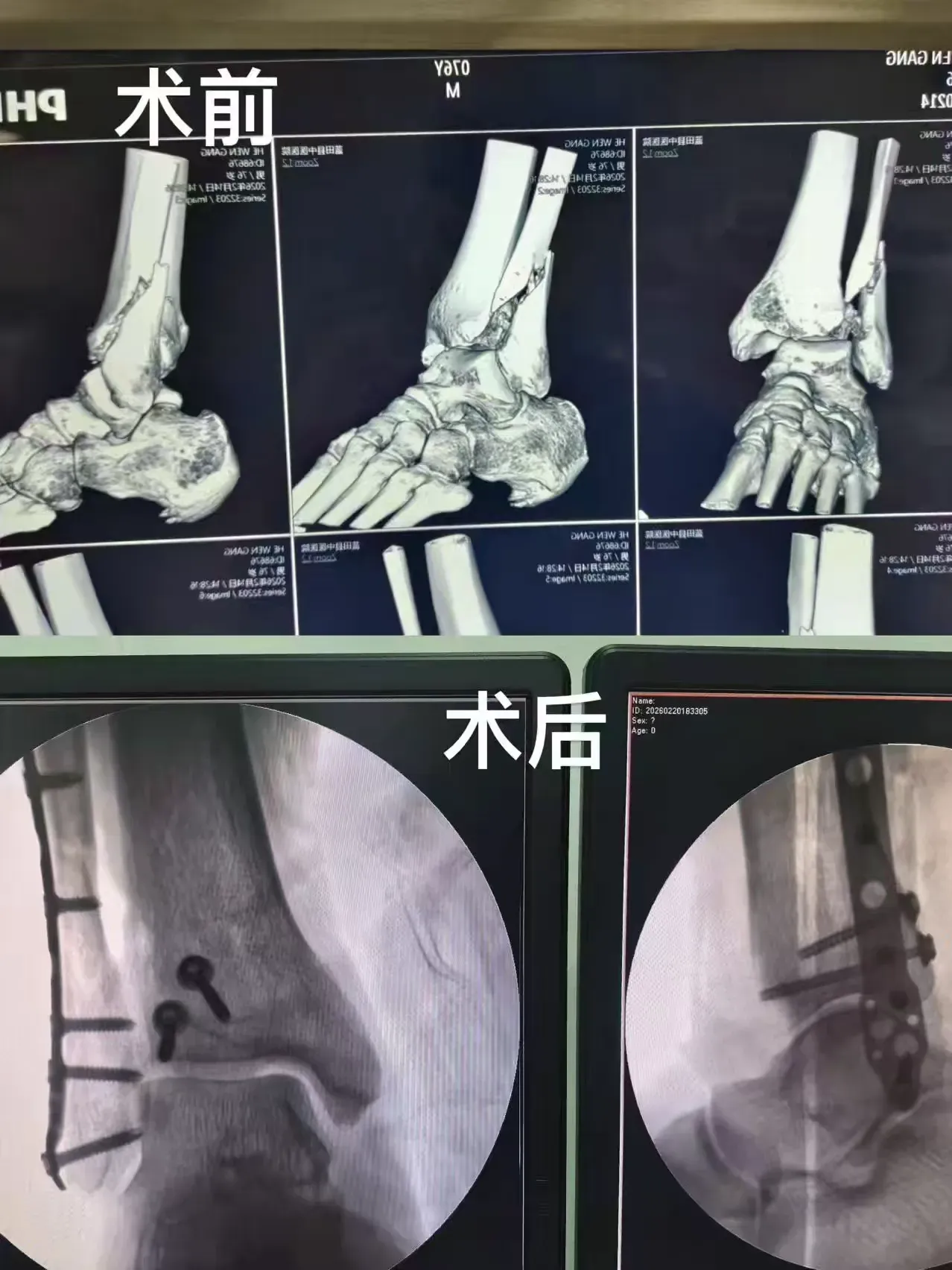 簡(jiǎn)篇-【藍(lán)中醫(yī)-手麻科】守醫(yī)者初心 護(hù)新春安康——藍(lán)田縣中醫(yī)醫(yī)院手麻科春節(jié)守護(hù)不打烊