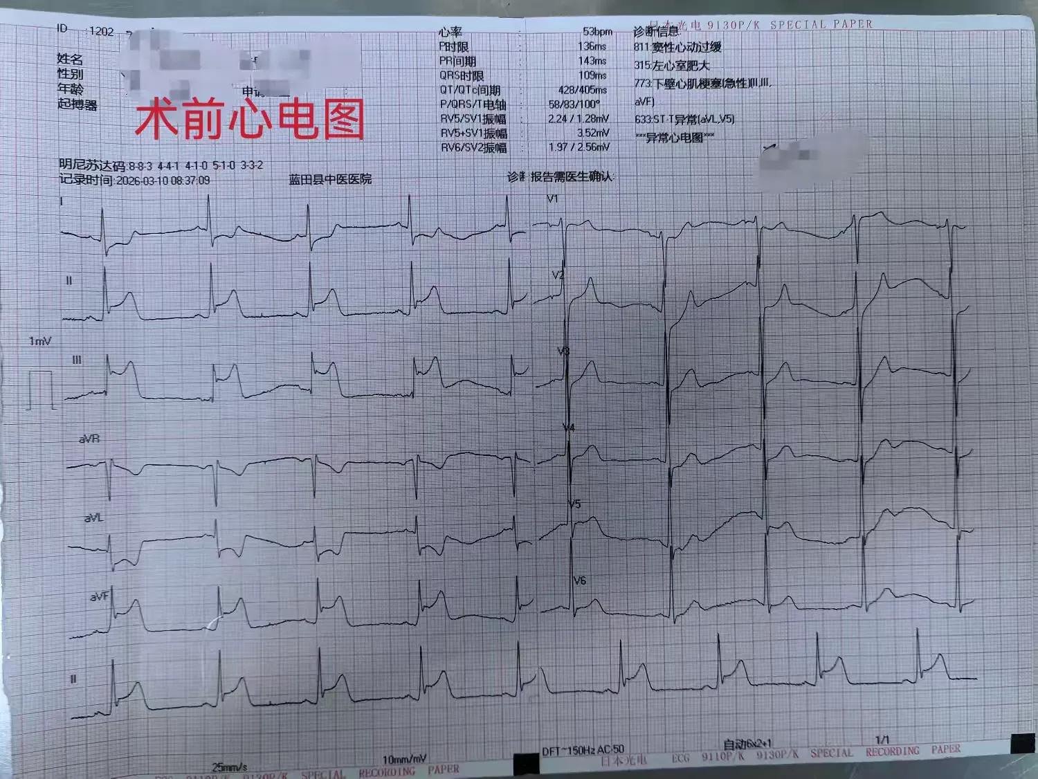 简篇-【蓝中医—心病科】当急性心梗心源性休克遭遇冠脉开口异常，看我们如何力挽狂澜